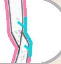 녹는 플레이트 고정 — 뼈 단면 확대
