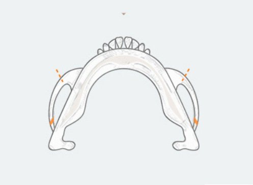 Step1 — 45도 광대 부분절골·옆광대 절골 그림