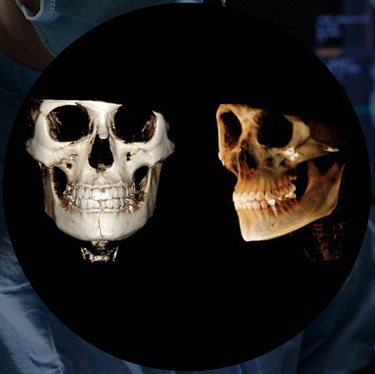 3D CT 두개골 정면·측면 영상