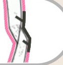 플레이트 고정 — 뼈 단면 확대