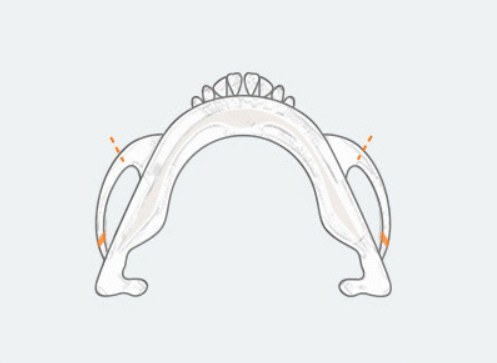 Step1 — 45도 광대 부분절골·옆광대 절골 그림