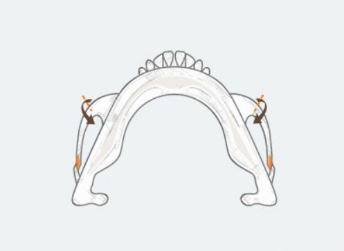 Step2 — 절골된 광대를 안쪽으로 밀어 넣는 그림