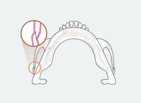 Step4 — 자가유합 유도 그림(골막 확대)
